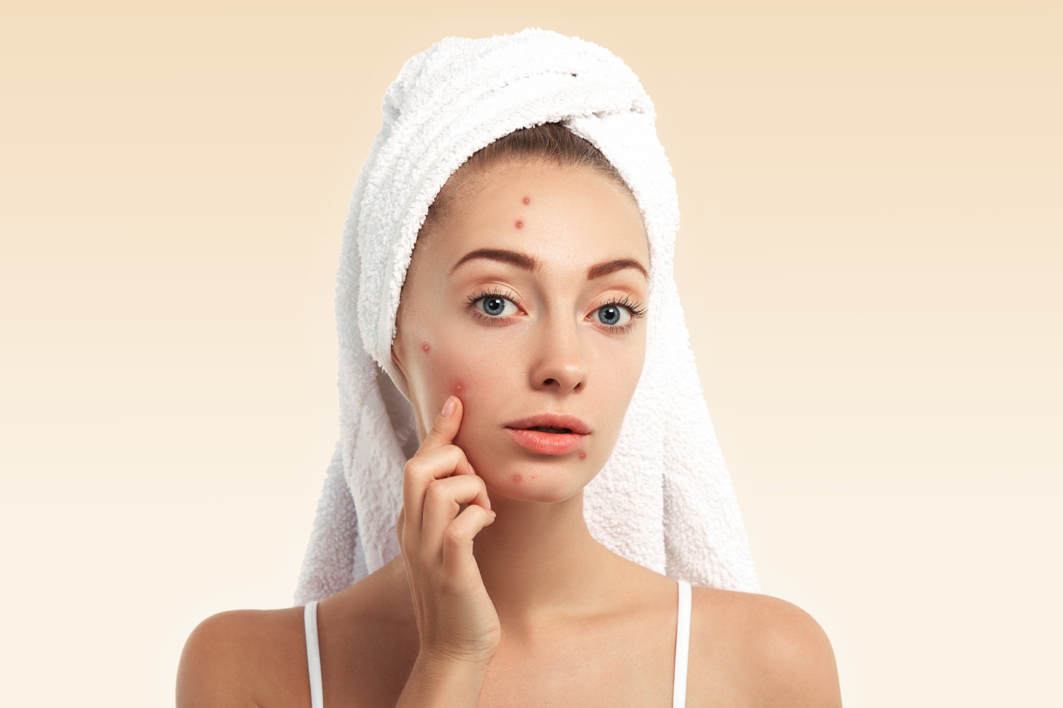 Acne Treatment